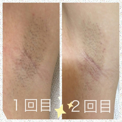 S様わき脱毛経過