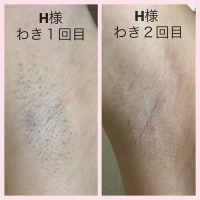 H様わき脱毛